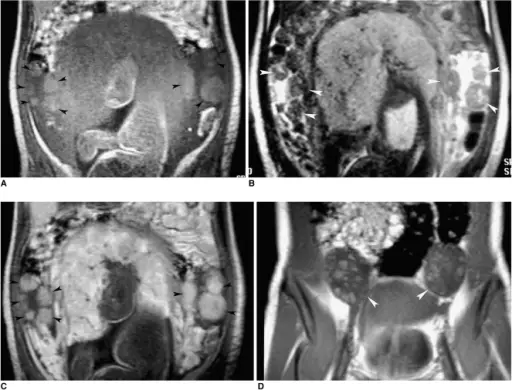 Pregnancy Luteomas