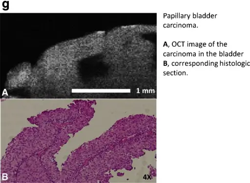 Premalignant and Malignant Epidermal Tumors