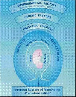 Preterm Premature Rupture of Placental Membranes