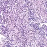 Primary CNS Lymphoma