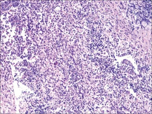 Primary CNS Lymphoma