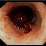 Primary Hemostasis