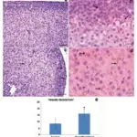 Primary Hyperthyroidism