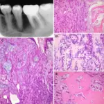 Primary Intraosseous Squamous Cell Carcinoma