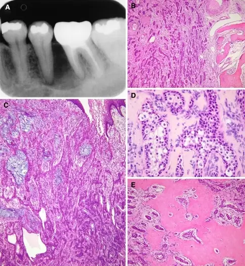 Primary Intraosseous Squamous Cell Carcinoma