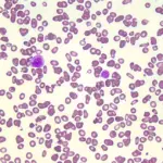 Primary Myelofibrosis