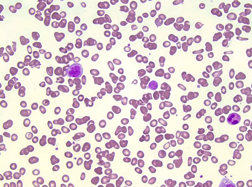 Primary Myelofibrosis