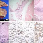 Primary Ovarian Carcinoid Tumors within a cystic teratoma