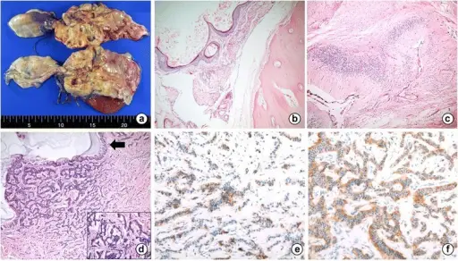 Primary Ovarian Carcinoid Tumors within a cystic teratoma