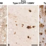 Prion Diseases