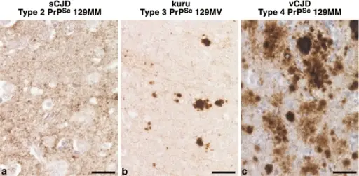 Prion Diseases