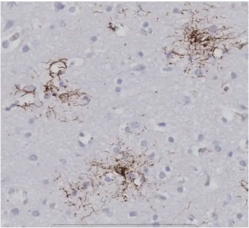 Progressive Supranuclear Palsy