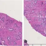 Prostate Adenocarcinoma