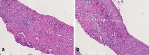 Prostate Adenocarcinoma