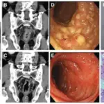 Pseudomembranous Colitis