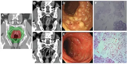 Pseudomembranous Colitis