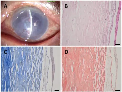 Pseudophakic Bullous Keratopathy