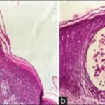 Psoriasis