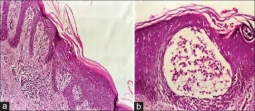 Psoriasis