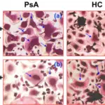 Psoriatic Arthritis