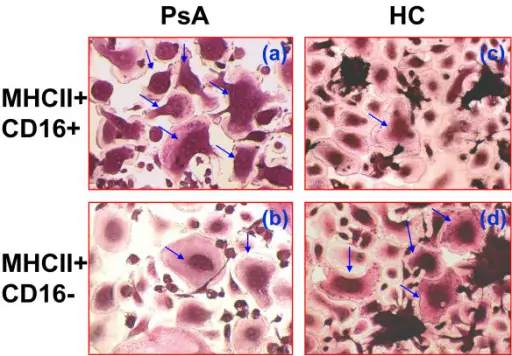 Psoriatic Arthritis