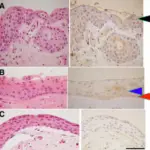 Pterygium