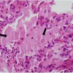 Pulmonary Alveolar Proteinosis