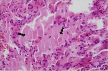 Pulmonary Alveolar Proteinosis