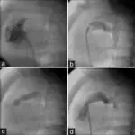 Pulmonary Atresia