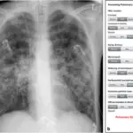 Pulmonary Edema