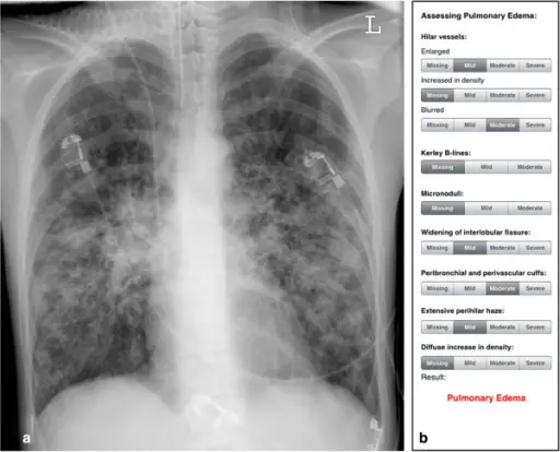 Pulmonary Edema