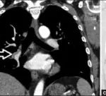 Pulmonary Embolism