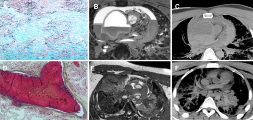 Pulmonary Embolism