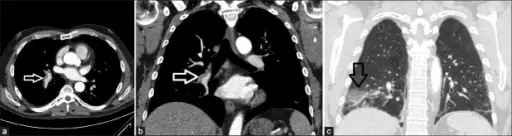 Pulmonary Embolism