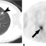 Pulmonary Eosinophilia