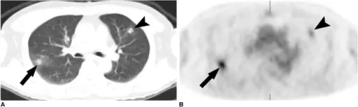 Pulmonary Eosinophilia