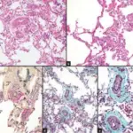 Pulmonary Hypertension