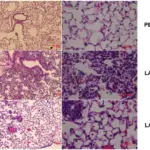 Pulmonary Infections