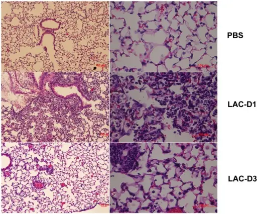 Pulmonary Infections