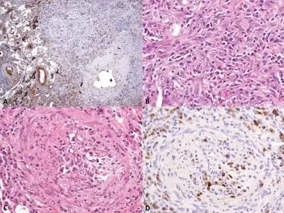 Pulmonary Involvement in Autoimmune Diseases