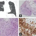 Pulmonary Langerhans Cell Histiocytosis