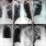 Pulmonary Pathology