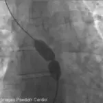 Pulmonary Stenosis