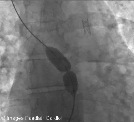 Pulmonary Stenosis