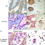 Pulmonary Tumors