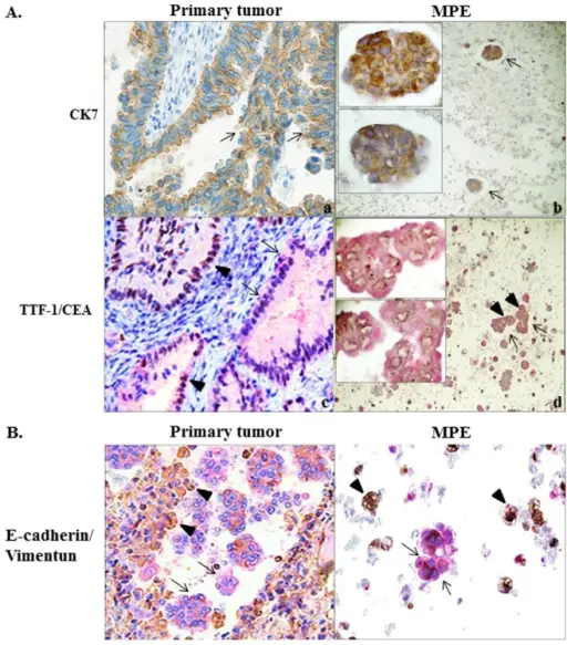 Pulmonary Tumors