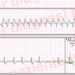 Pulseless Electrical Activity