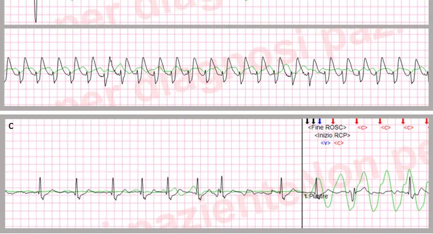 Pulseless Electrical Activity