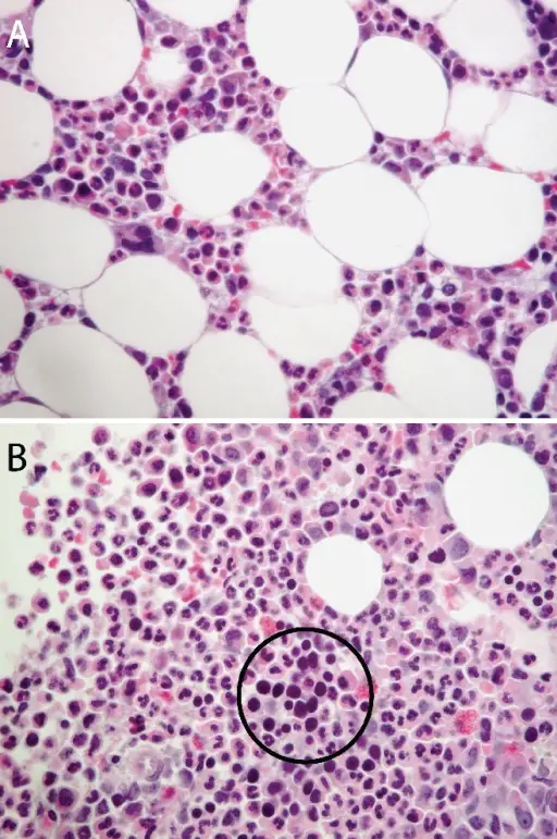 Pure Red Cell Aplasia