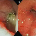 Pyloric Stenosis